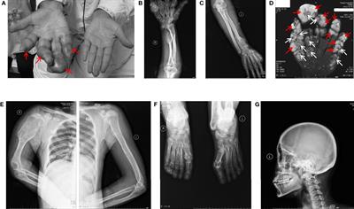 IDH1 R132C and ERC2 L309I Mutations Contribute to the Development of Maffucci’s Syndrome